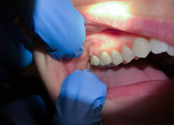 Best Emergency Wisdom Tooth Extraction in Freeland, MI